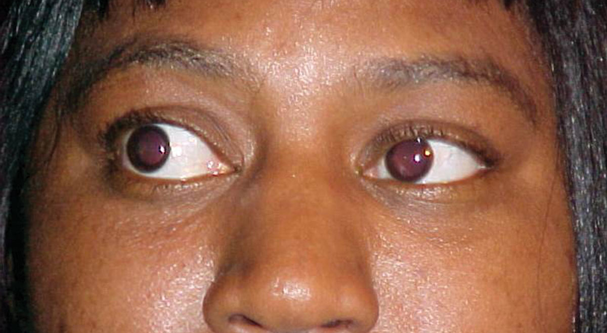 What Are The Signs Of Thyroid Eye Disease